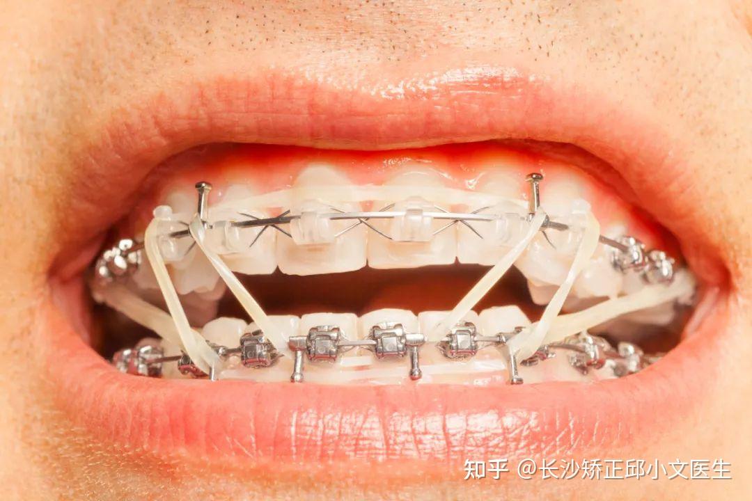 那么扩弓就可以扩大牙槽骨的容量,让牙齿获得移动空间