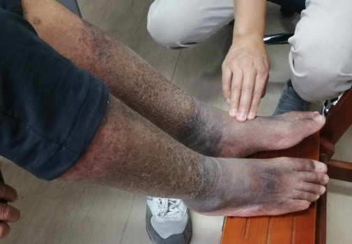 呵护手足,从秋天开始,要小心糖尿病足