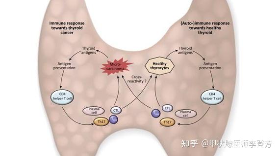 全面解读甲功报告的3个抗体tpoab,tgab,trab