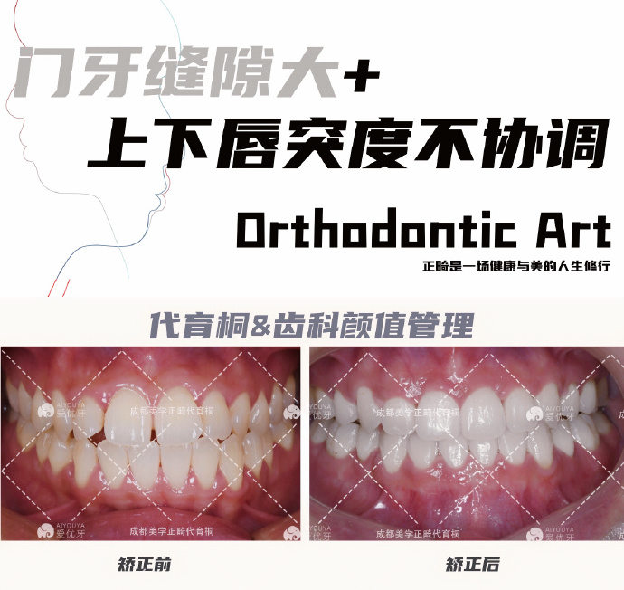 正畸治療中,確保咬合健康的基礎上,我會盡可能去實現患者想達到的目標