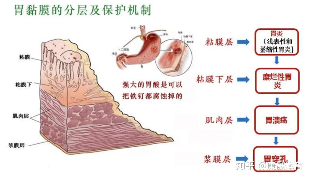 或是服用非甾体抗炎药(如阿司匹林,布洛芬)对肠胃造成的直接损伤