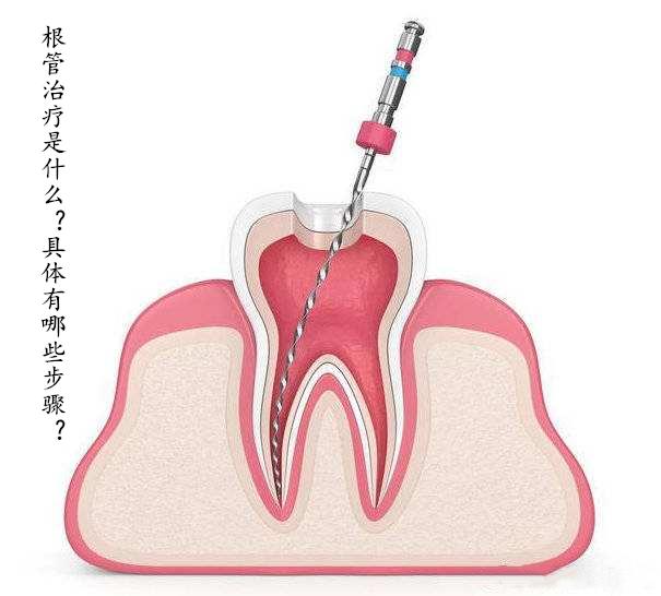 而且治療的費用還特別高,根管治療也就是抽牙神經,是口腔疾病中最常用