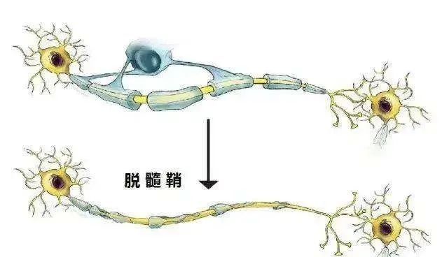 脱髓鞘症的病因仍是个谜