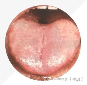 史上最全舌诊图谱!【珍藏版】 - 知乎