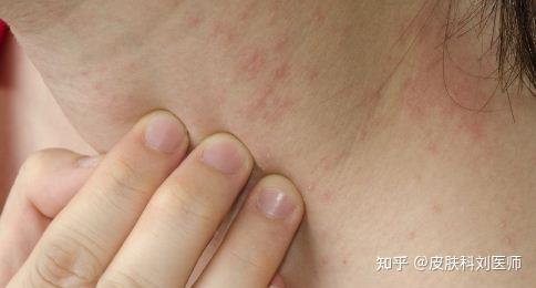 春天容易出现哪些常见的皮肤病 知乎
