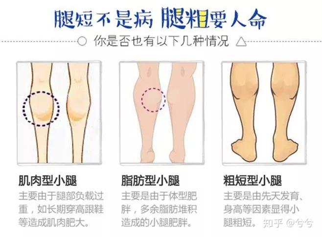 小粗腿基本上分类为——肌肉型,脂肪型,粗短型.