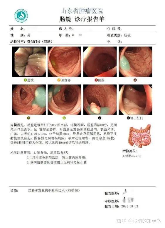 肠息肉早期大便图片图片