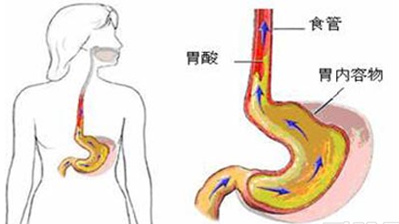 經常感覺胸口難受,可能是反流性食管炎搞的鬼