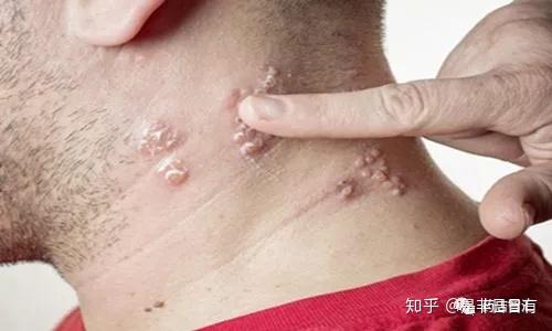 典型症状:带状疱疹病毒俗称生飞蛇,患处皮肤潮红,后期进而出现多数