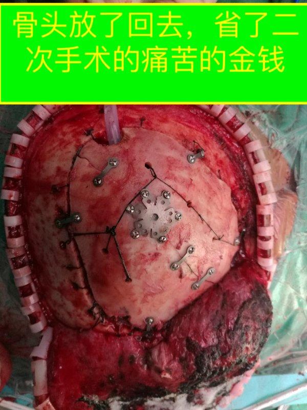 对于这种急诊手术,手术第一目的是保障患者的性命,其次才考虑功能.