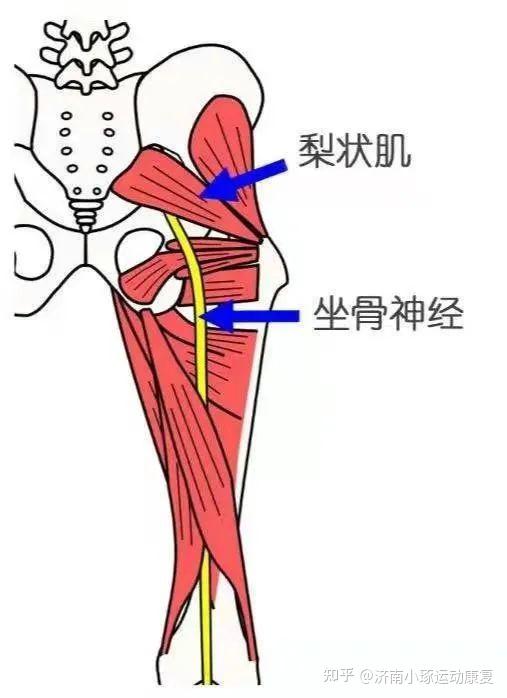 臀部疼痛請小心梨狀肌綜合徵