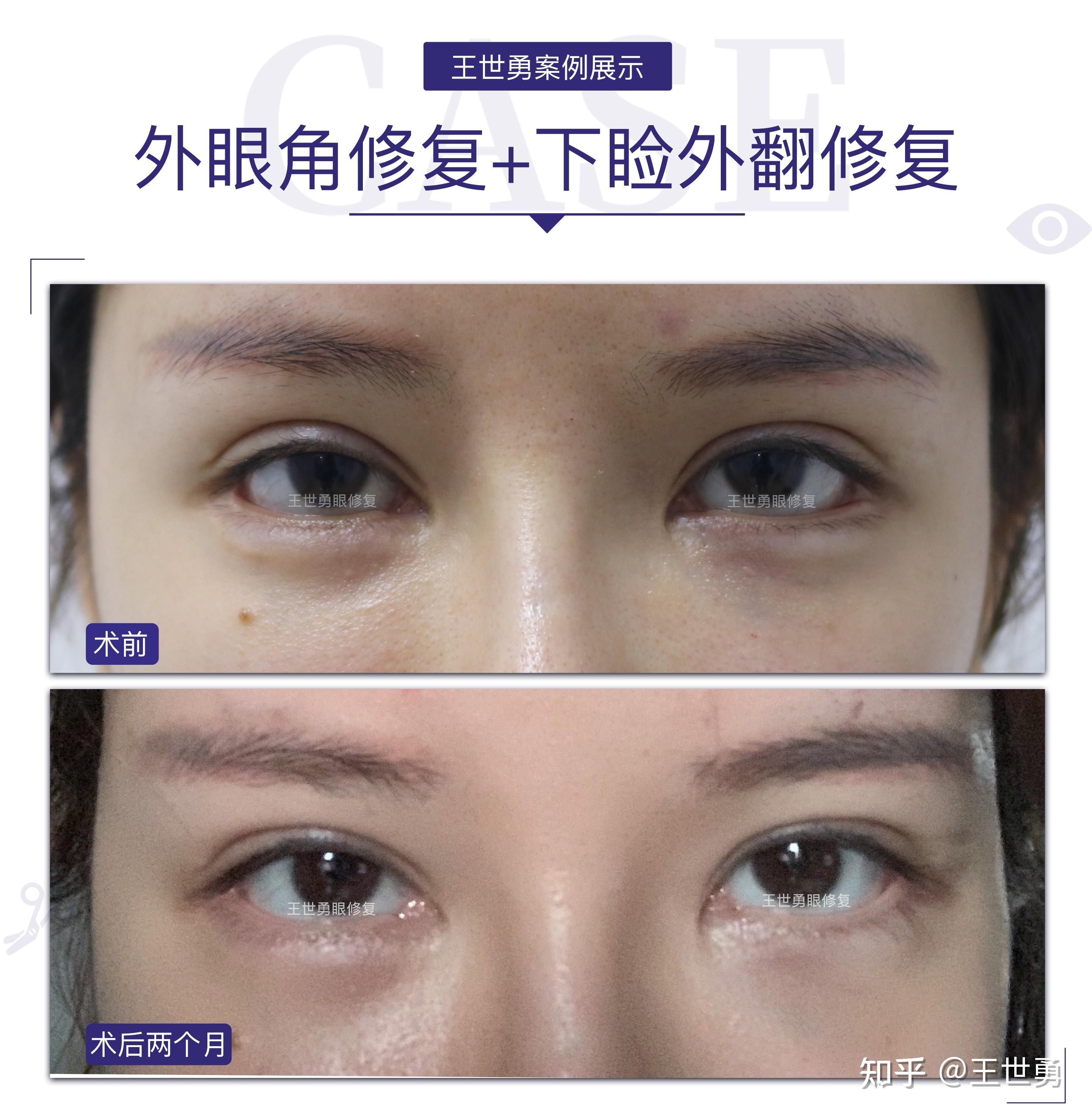 下睑缘贴附于黑眼球,解决露白现象解决豁口,露红,外翻等问题整体眼部