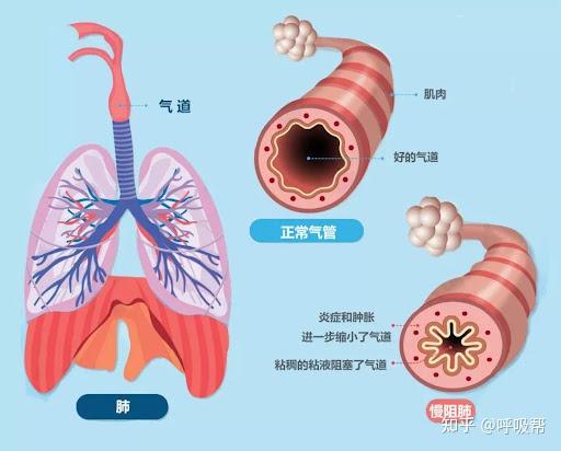 异常呼吸类型5种图片图片