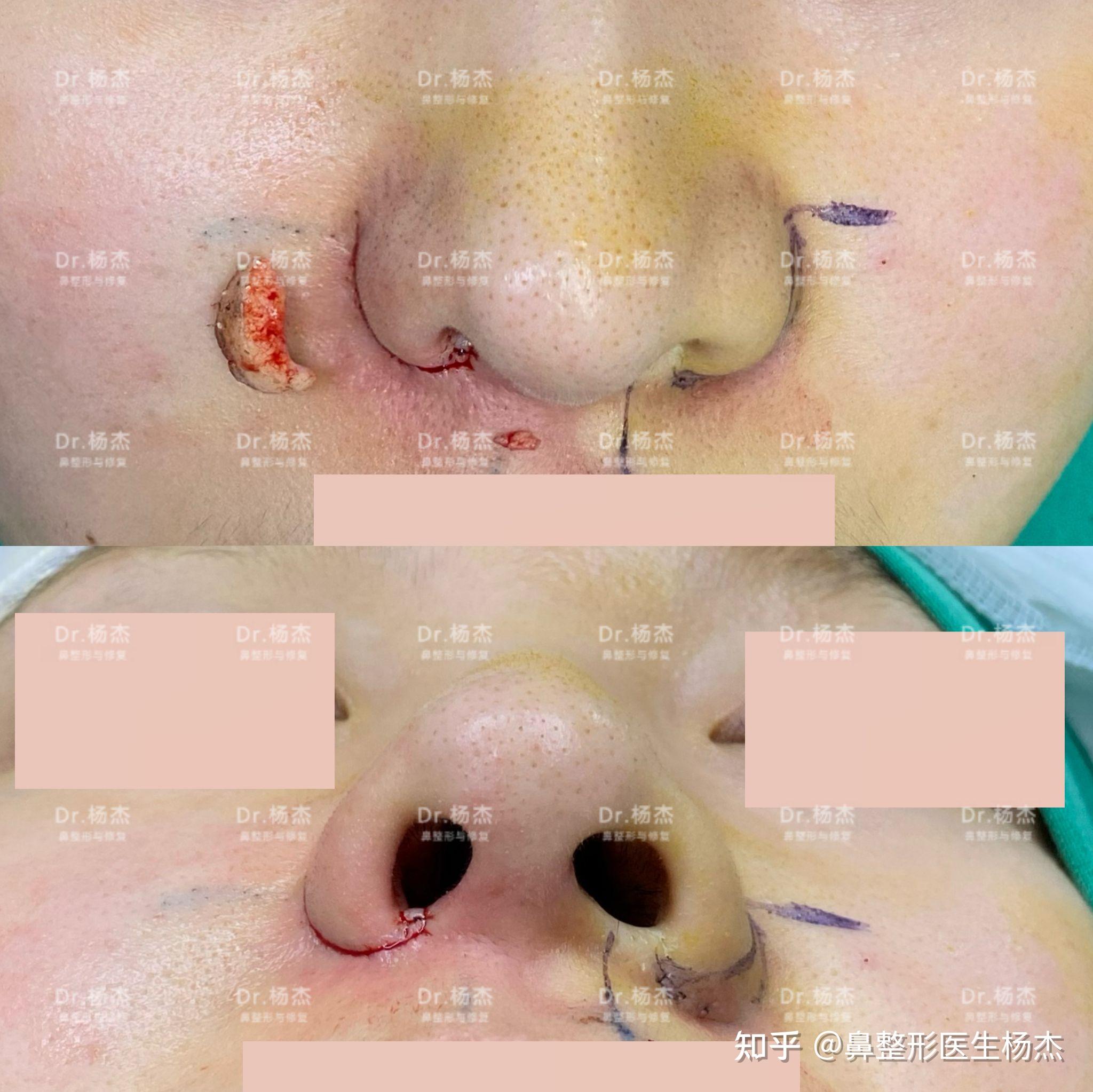 儘量調整鼻翼正面對稱性,兼顧兩側鼻孔協調性,傷口精細縫合.