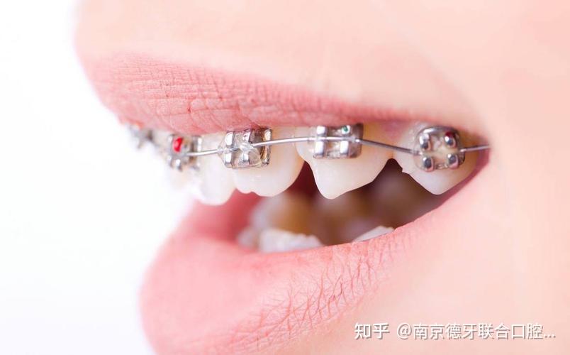 南京德牙联合口腔医院:牙缝过大牙齿矫正的方法 - 知乎
