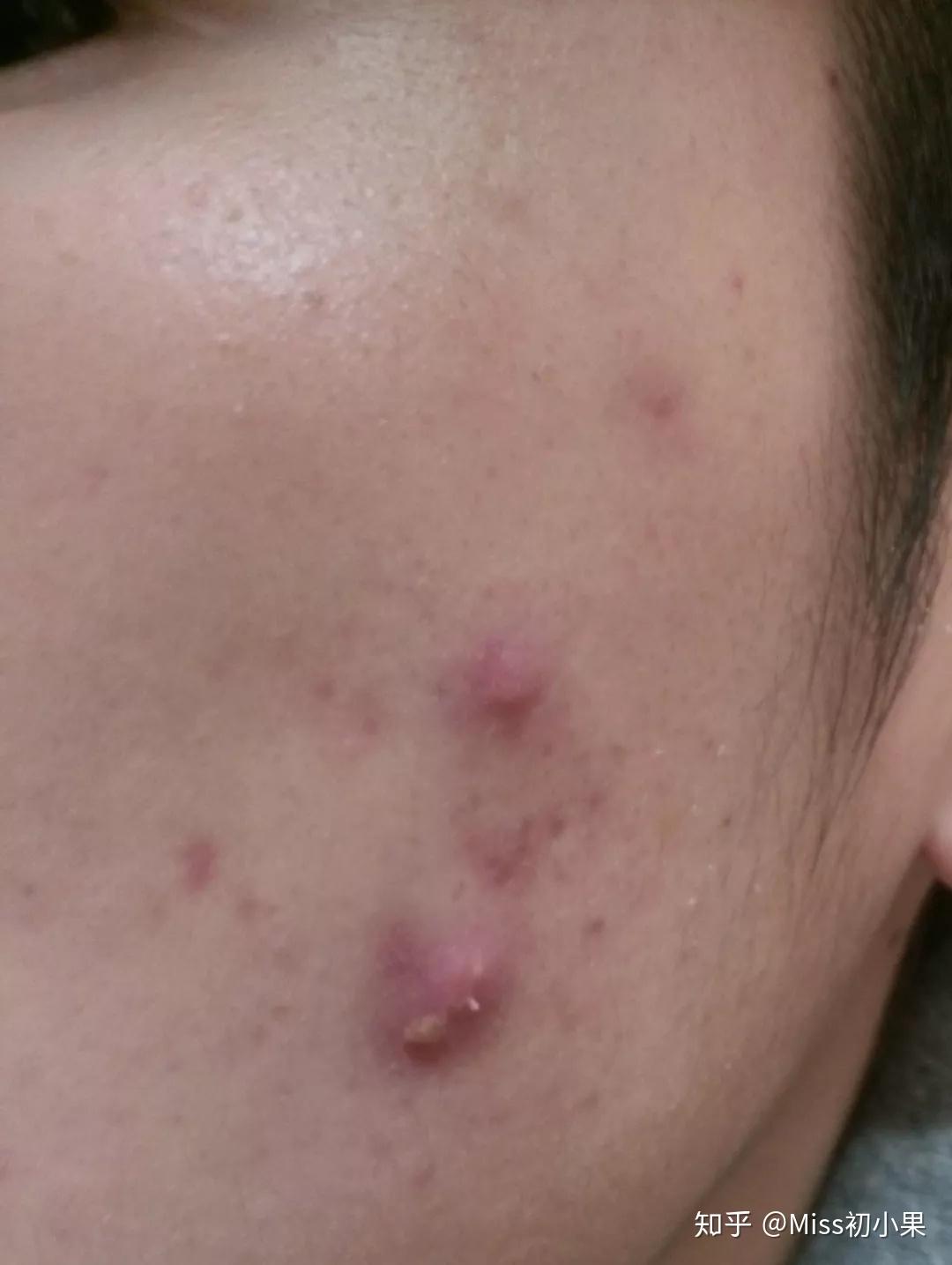 休眠火山痘攻略