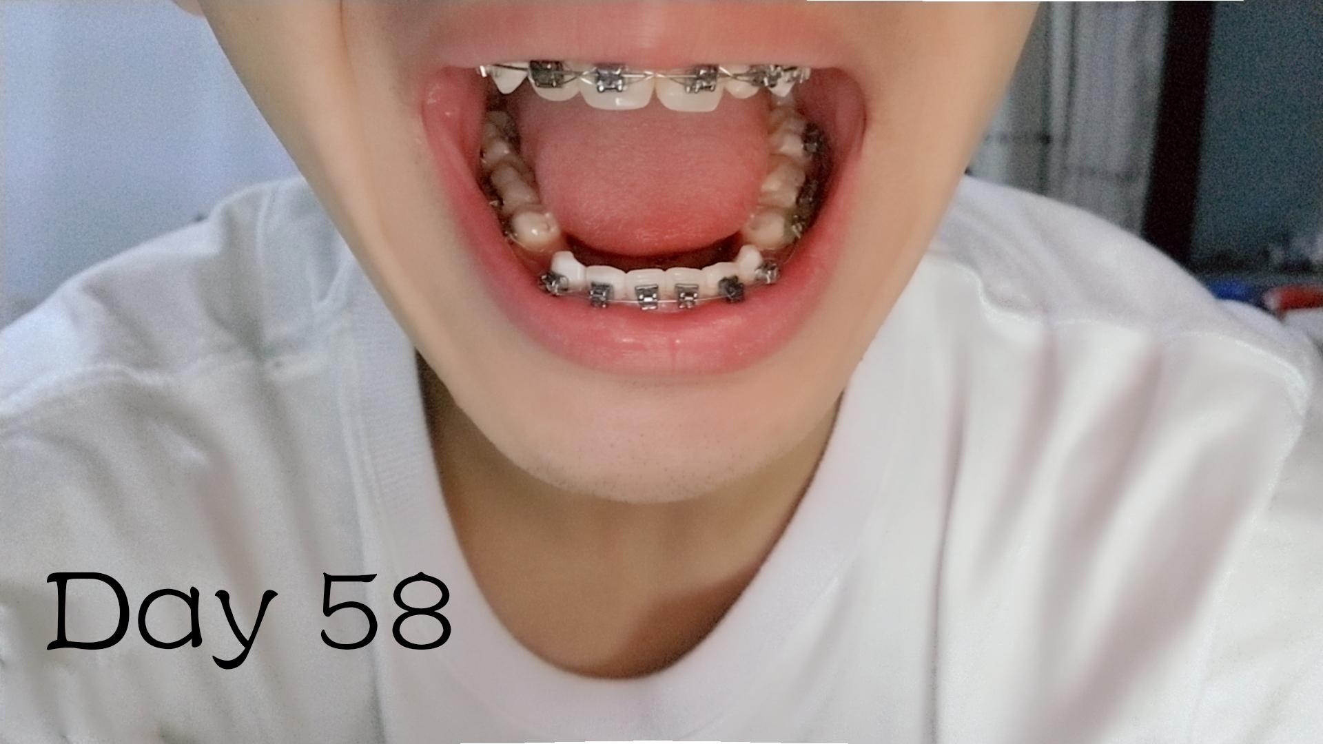 每月更新带牙套的变化过程🦷（更新：2021年1月26日） - 知乎