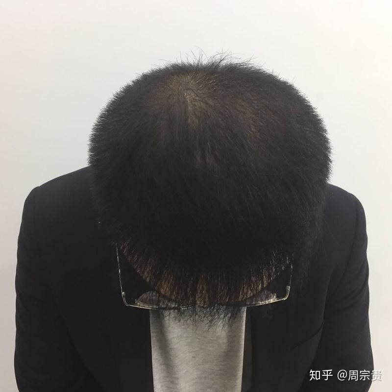 头顶大面积稀疏3500单位就能达到浓密吗