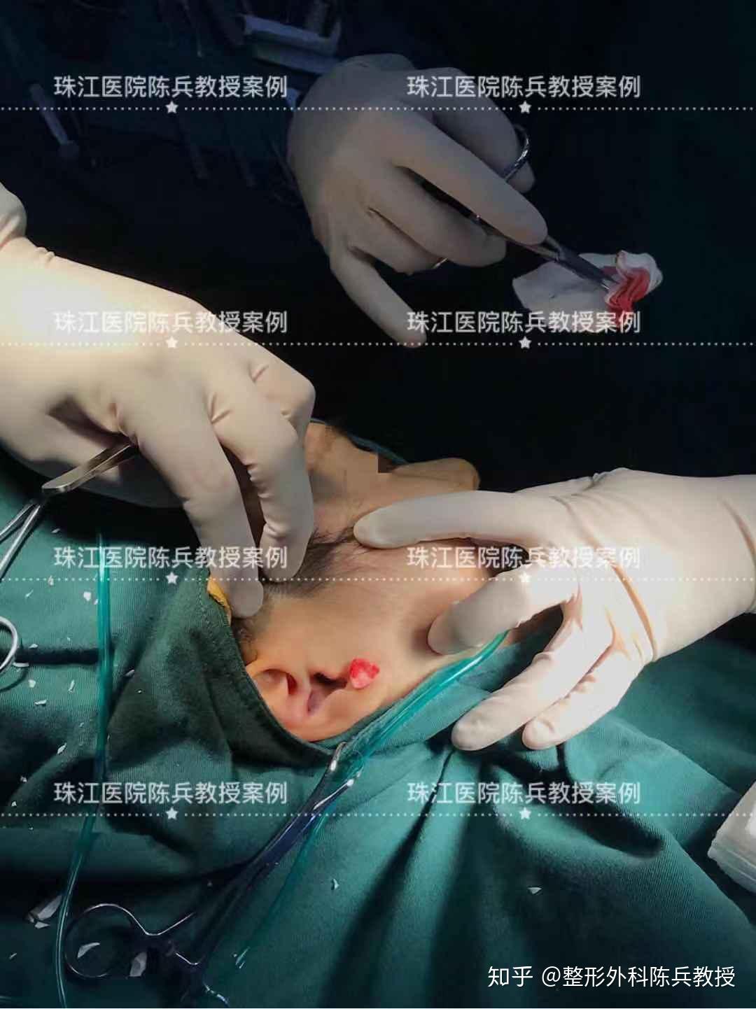 鼻孔太大如何缩小鼻孔