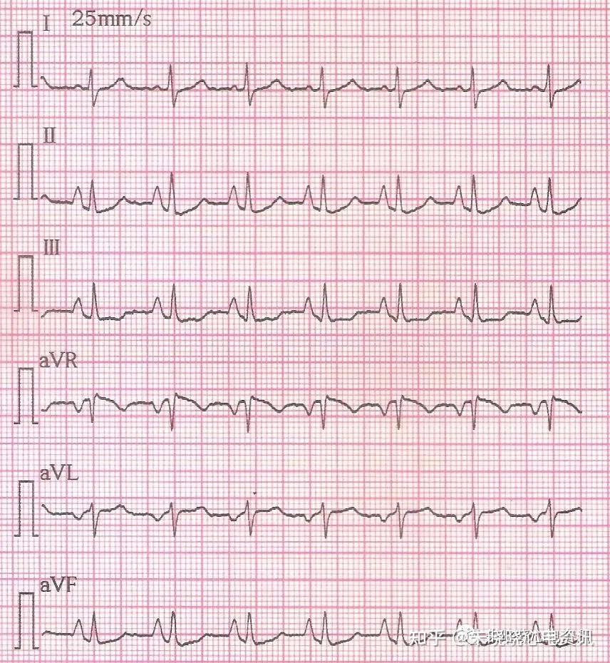 慢性肺心病心电图图片