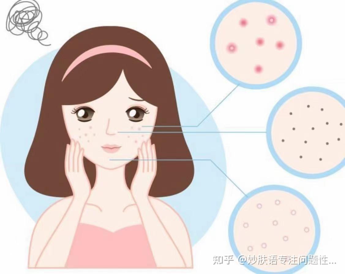 激素脸戒断期多久