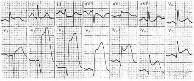 心電圖st段抬高就是心梗還可能是這些病