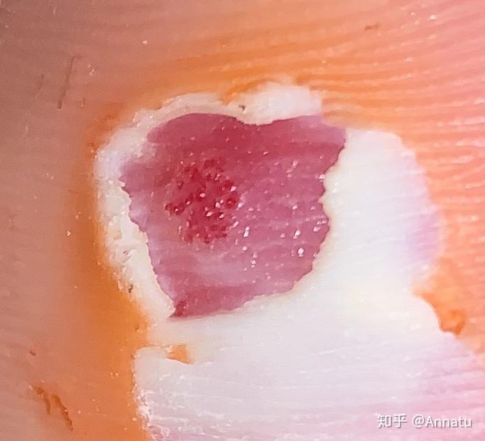 我的第一篇文章居然写的是鸡眼、跖疣？ 知乎