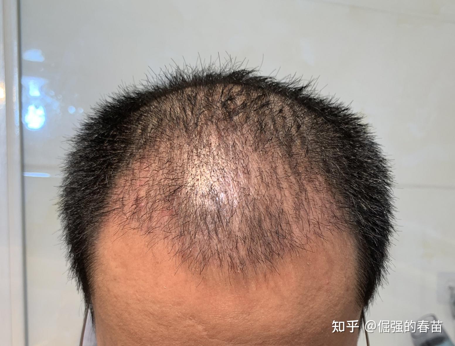 植发后清理角质掉发(植发后头上的角质多久可以退去)