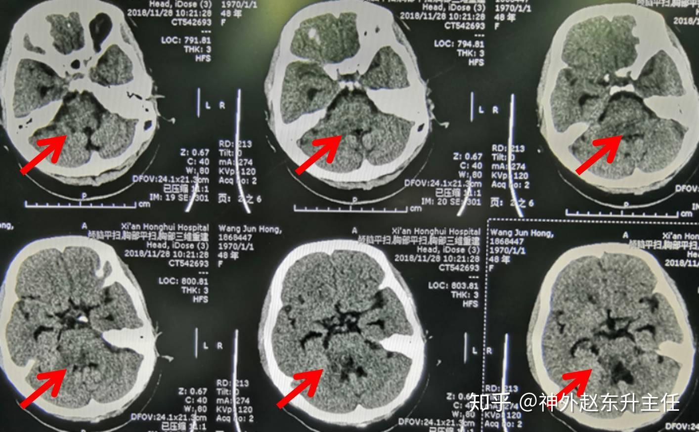 脑干出血死亡率图片