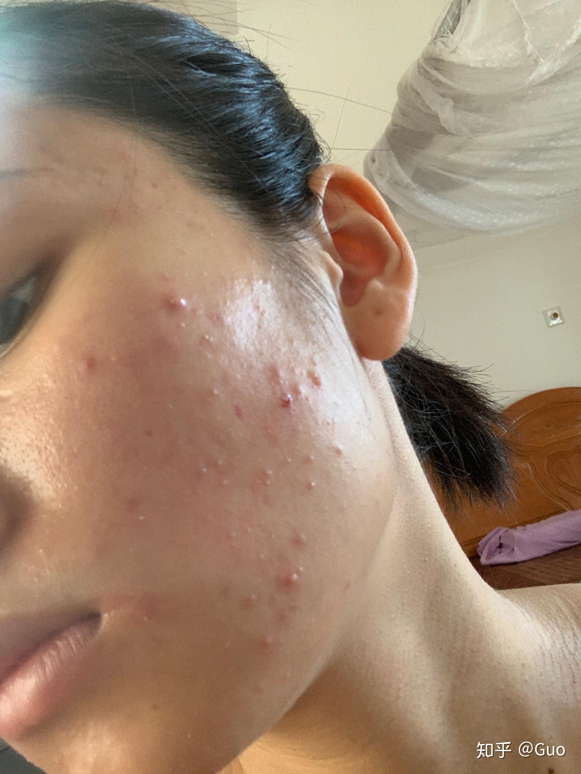 长全脸痘痘怎么办