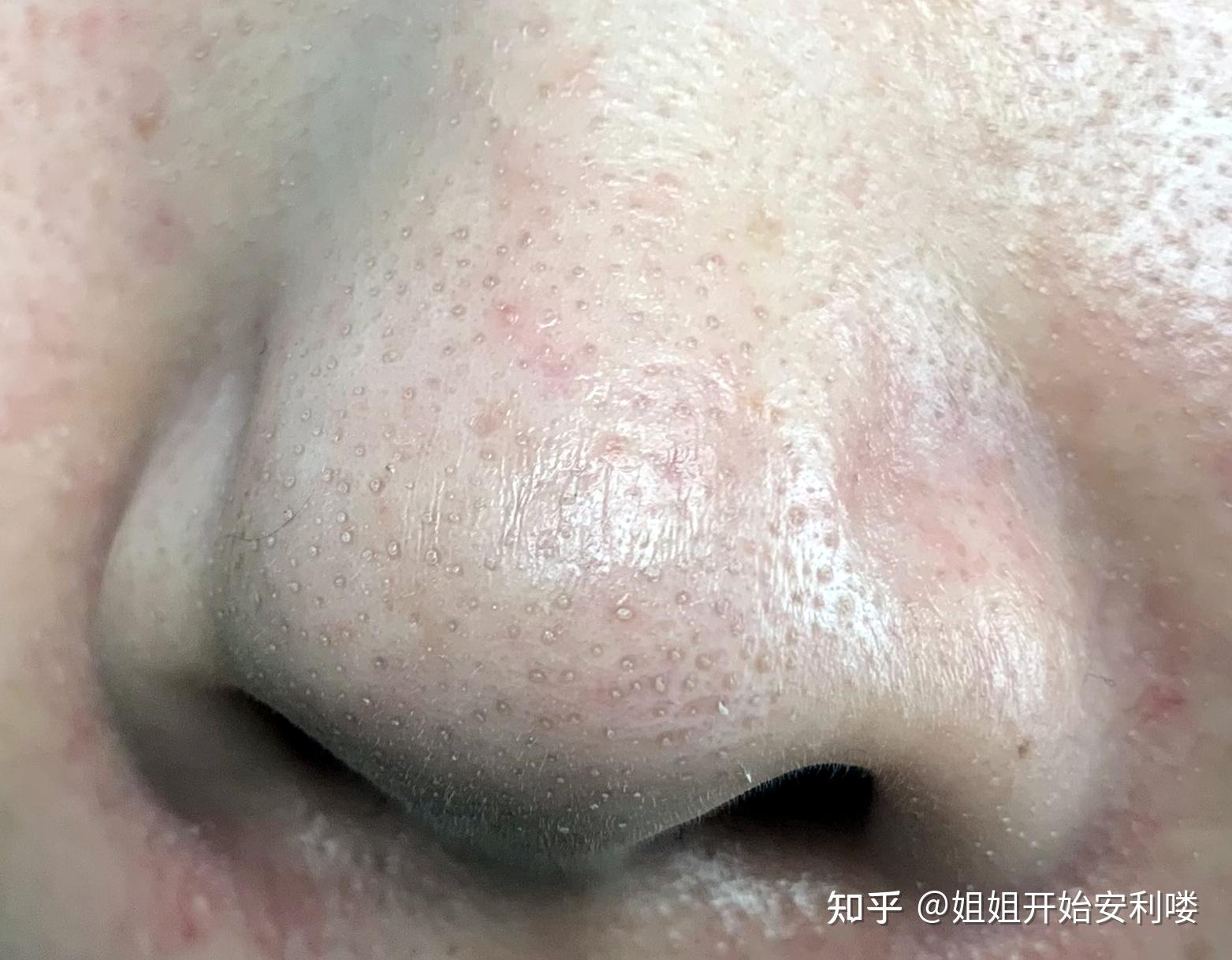 甲硝唑和壬二酸可以去黑头吗?