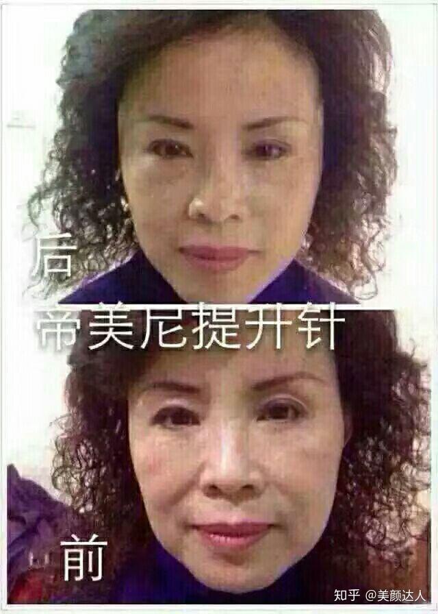 强大的帝美妮提升针 一次注射30