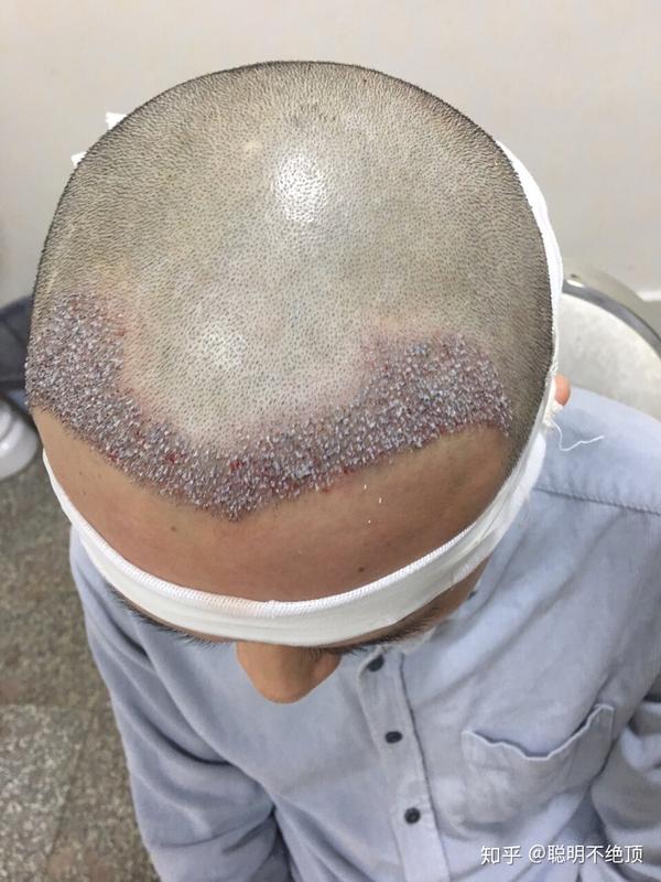 个人植发经历献给所有的脱发患者