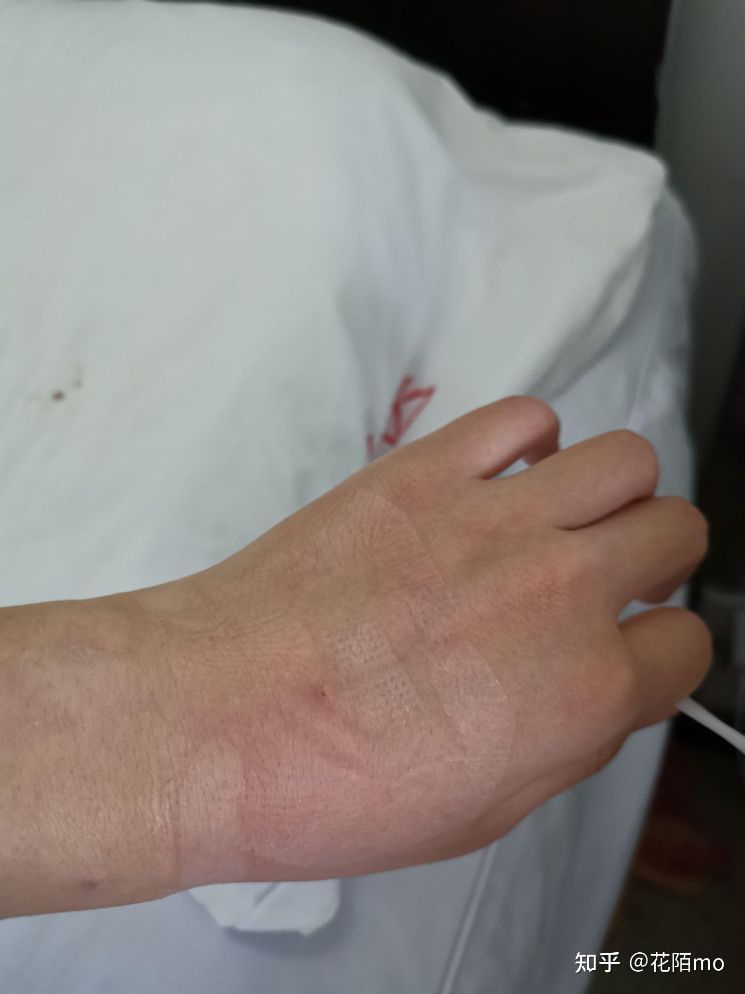 记录我的超大双侧卵巢畸胎瘤13cm 7cm