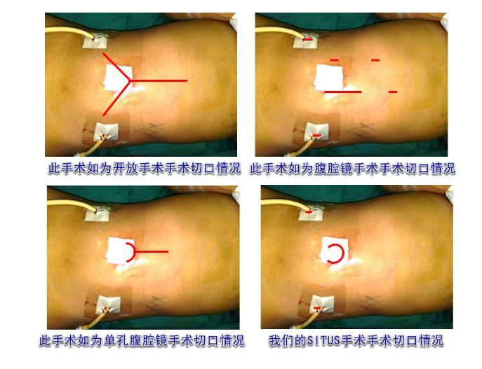 西安唐都医院完成单切口经脐三角腹腔镜 马蹄肾切除合并对侧肾复位