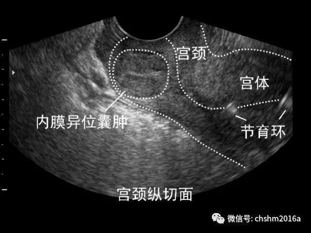 宫颈子宫内膜异位囊肿声像图14