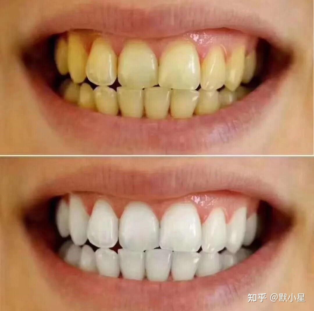 时克闪耀亮白牙贴去黄洁白牙齿清洁神器去黄牙速效美牙贴变白牙膜