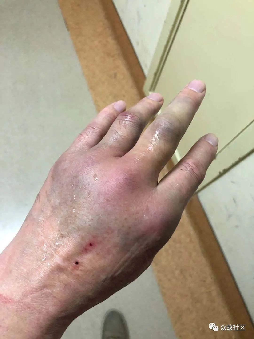 主任的手被打骨折了发生在上海东方雅苑小区的打人事件