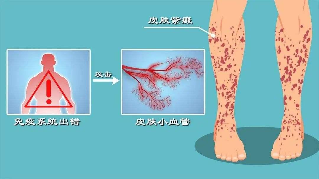 【重庆朝天门医院】过敏性紫癜就是过敏吗?这病应该怎么治?