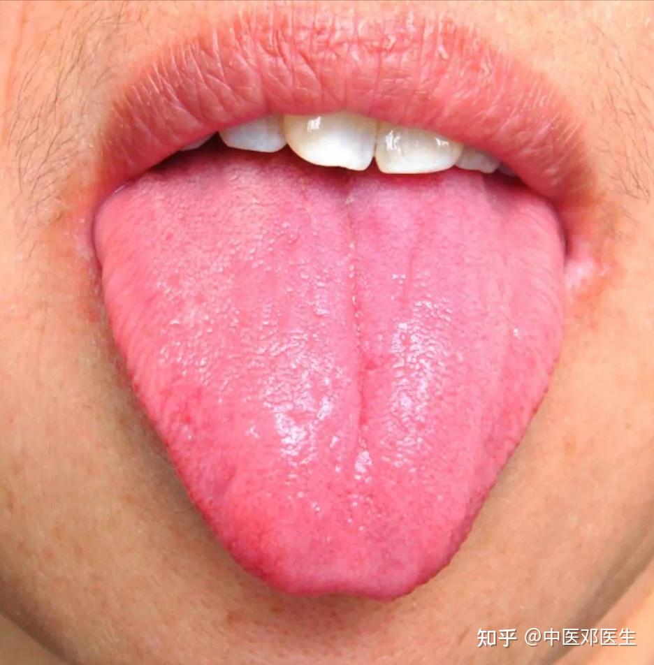 正常舌苔图片 女性图片