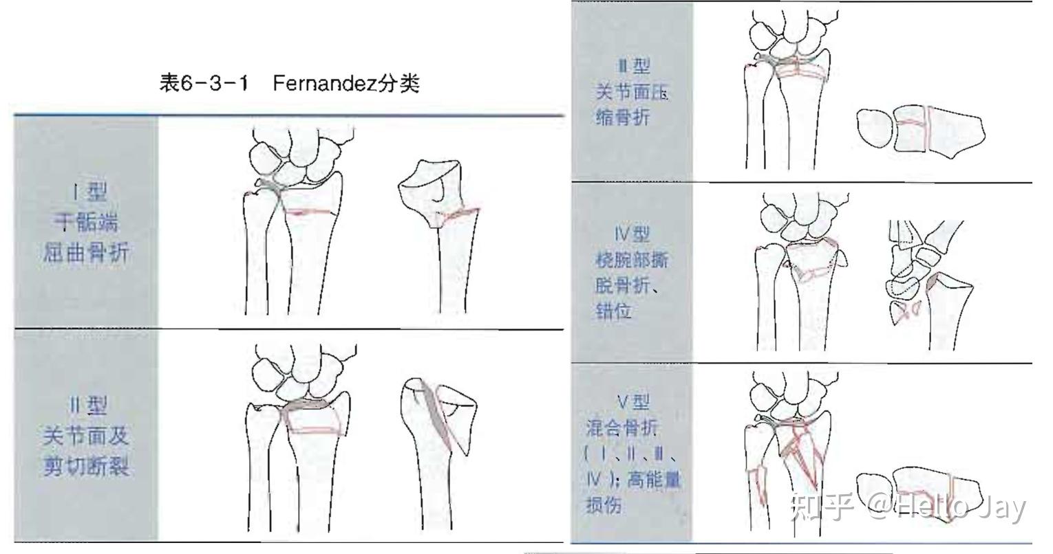 桡骨远端和腕关节骨折的治疗原则