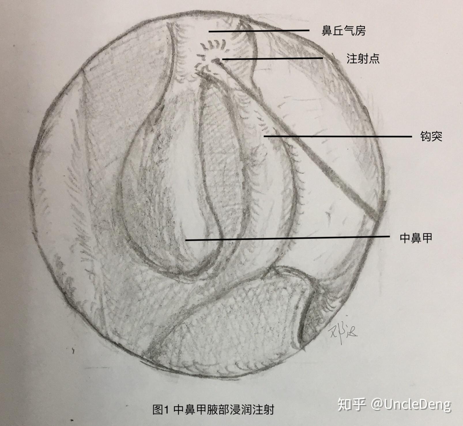 fess手术1例