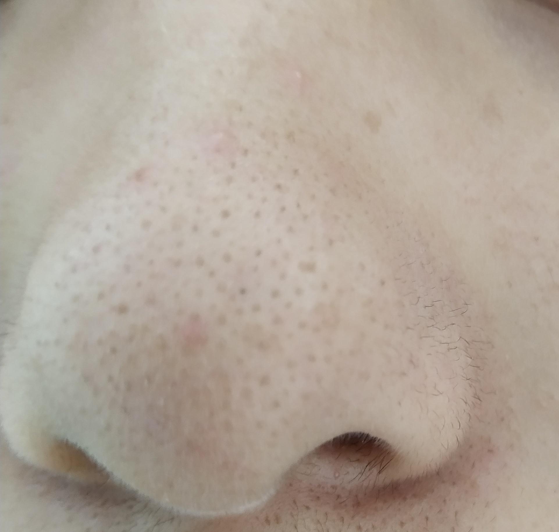 柜姐冰雪聪明,还是回答侬们的问题吧你鼻翼两侧都是毛?