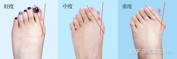 拇外翻—我们该怎么办? - 知乎