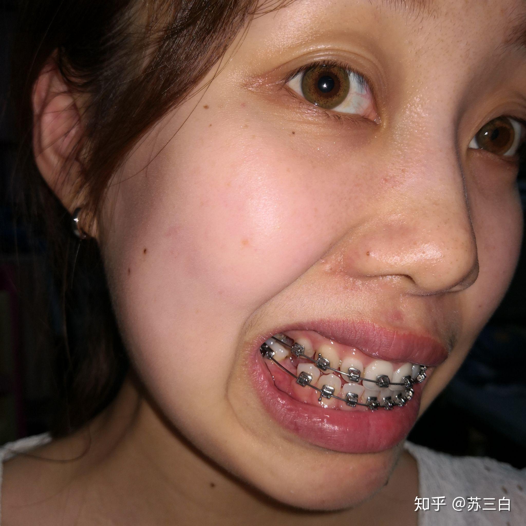 骨性嘴凸,牙齿矫正,上海口腔病防治院