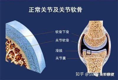 关节软骨损伤怎么办 看权威专家如何解答 知乎