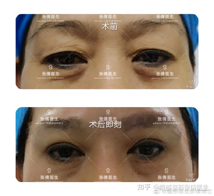 案例48悬眉术治疗前后的效果对比
