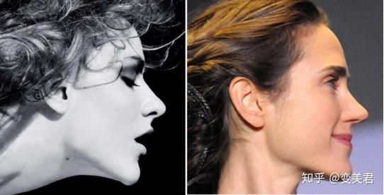 什么样的鼻子不适合整 v2-133336f74e08f7d8fed8d4f7210b9eb6_r.jpg