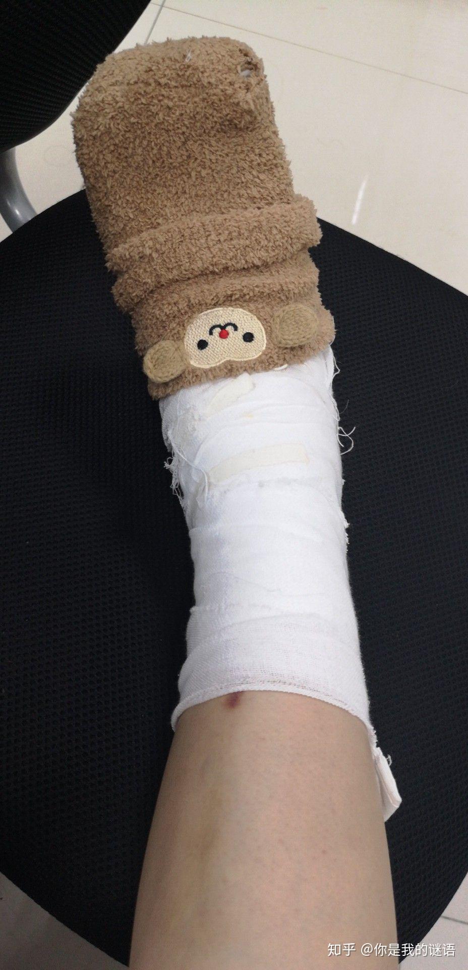 关于脚踝扭伤记录