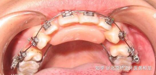 深覆颌深覆盖矫正固定平导